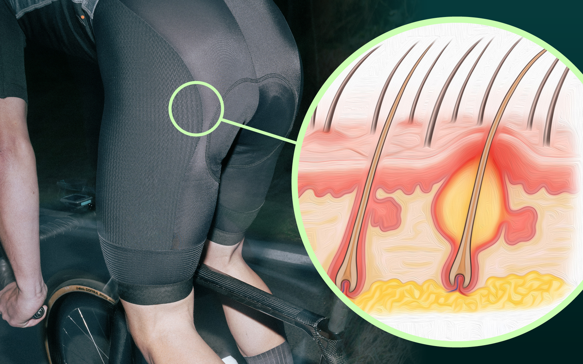 Posedla Academy | Pressure ulcers and infections (e.g., furuncles) in